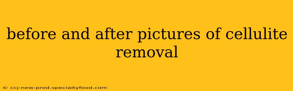before and after pictures of cellulite removal