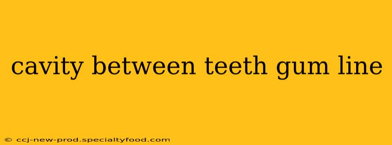 cavity between teeth gum line