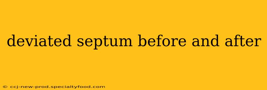 deviated septum before and after
