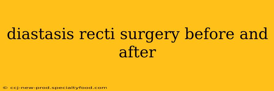 diastasis recti surgery before and after