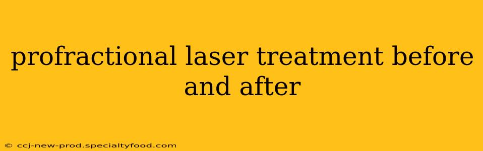 profractional laser treatment before and after